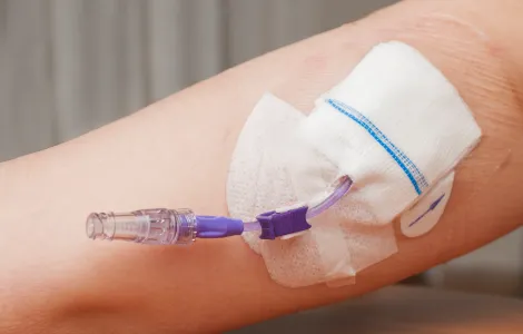 PICC(末梢留置型中心静脈カテーテル)留置術