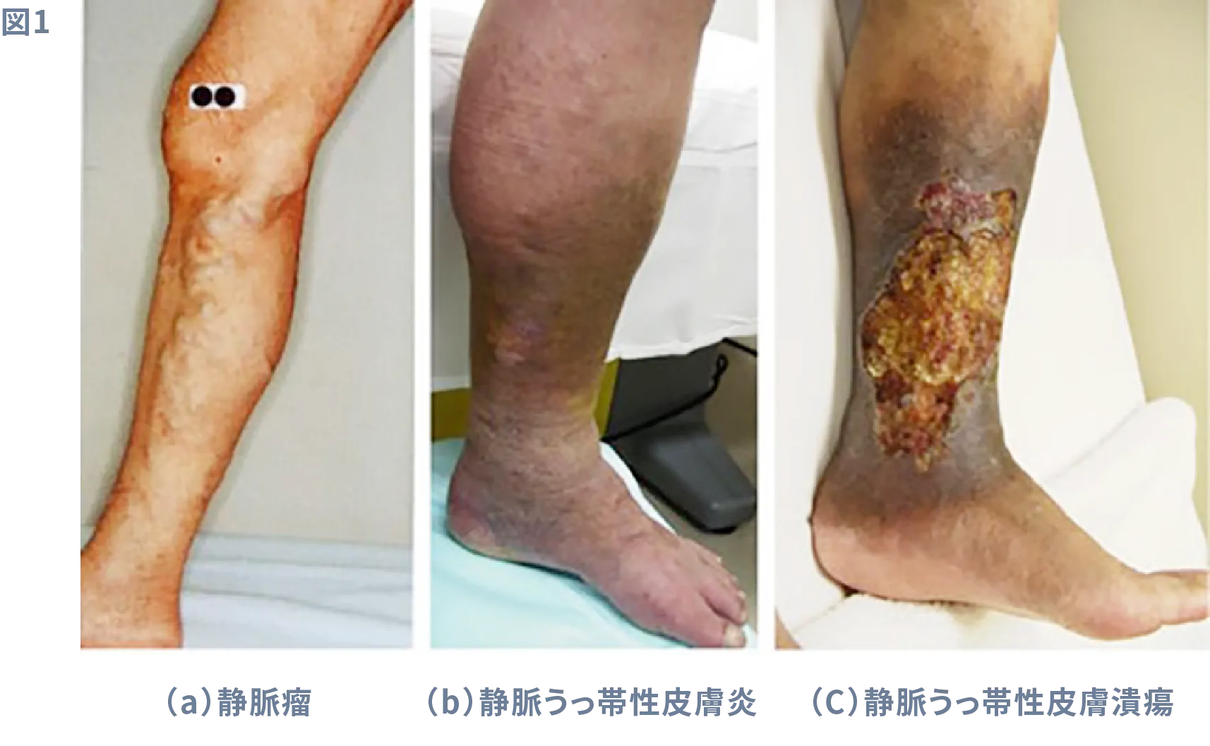 下肢静脈瘤の症状