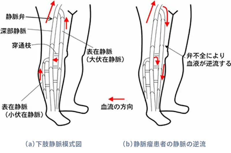 下肢静脈瘤の病態