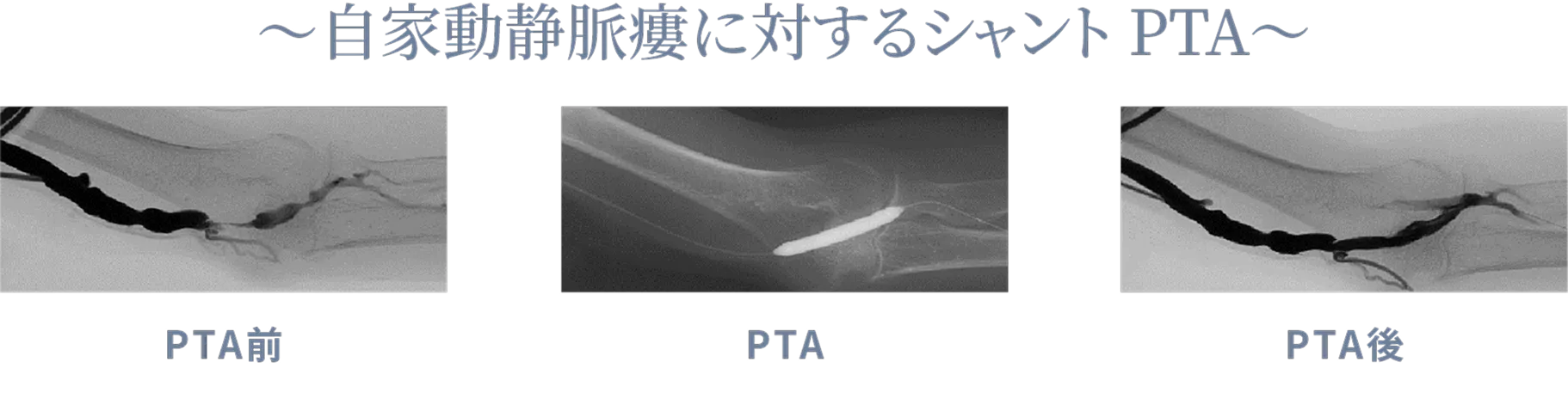 ~自家動静脈瘻に対するシャントPTA~