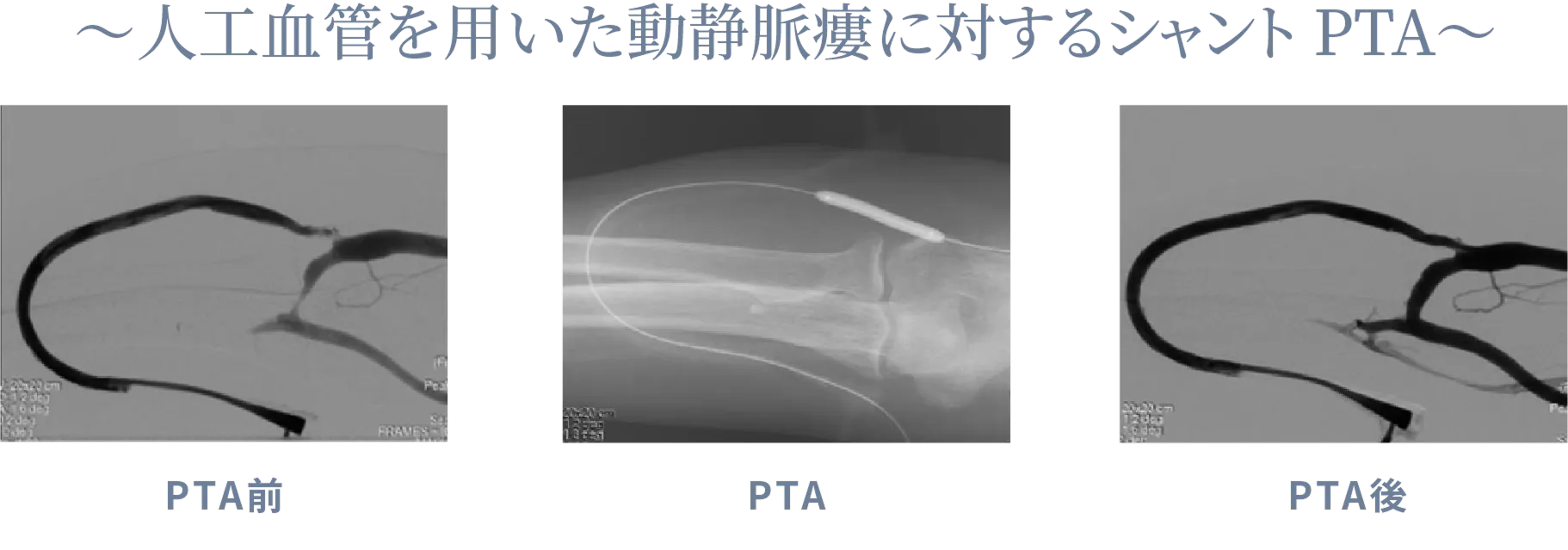 ~人工血管を用いた動静脈瘻に対するシャントPTA~