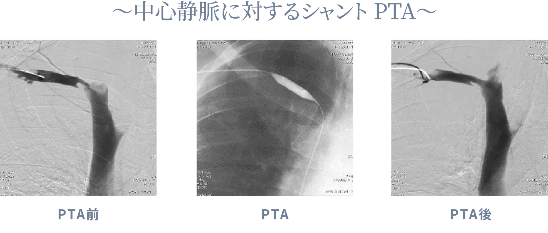 ~中心静脈に対するシャントPTA~