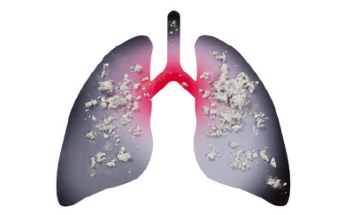 肺がんの確率は？