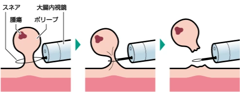 大腸カメラ検査について