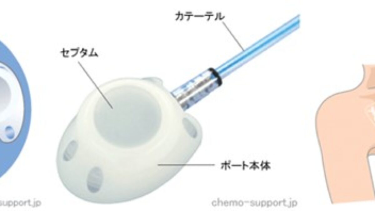 CVポート留置術｜MYメディカルクリニック日帰り手術センター シャント手術・下肢静脈瘤・CVポート留置術等に対応