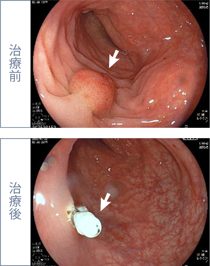 大腸カメラ検査について