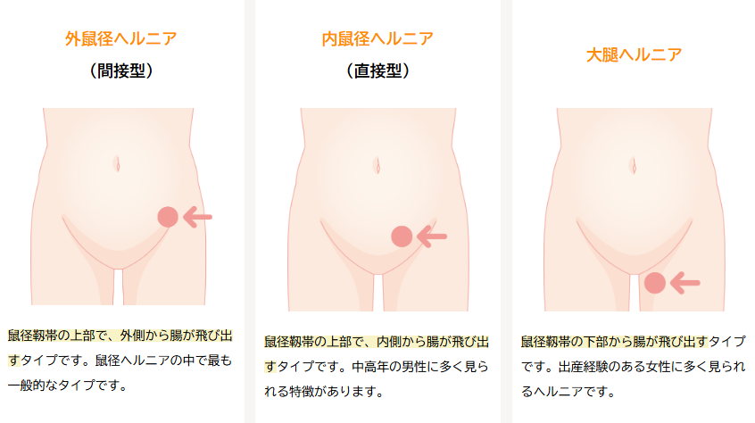 鼠径ヘルニア