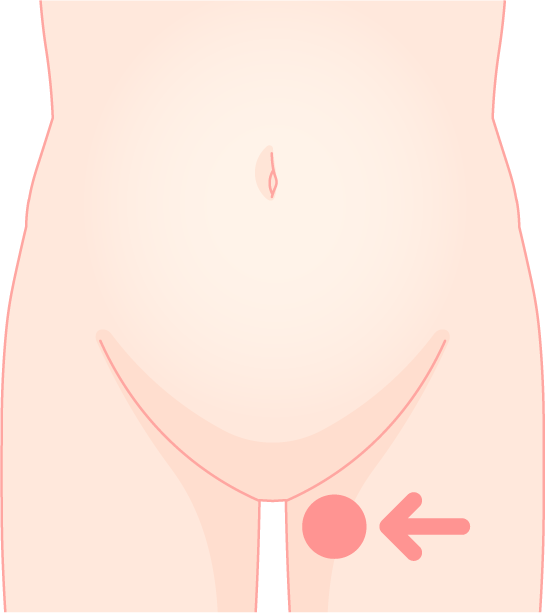 大腿ヘルニア