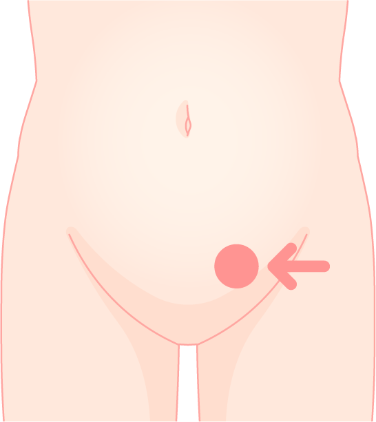 内鼠径ヘルニア