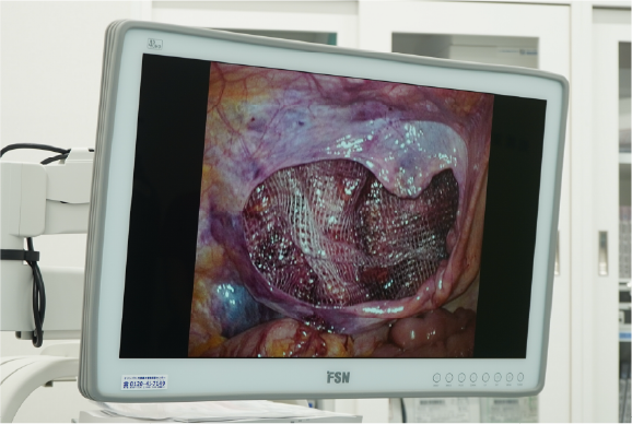 腹腔鏡手3