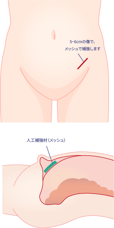 前方アプローチ（鼠径部切開）